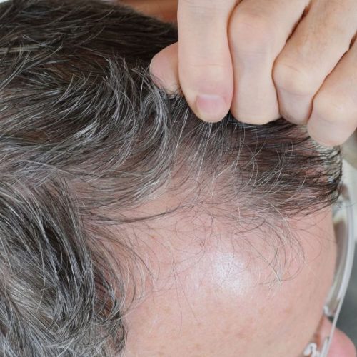 Conoce algunas de las posibles causas de la caída del cabello que te sorprenderán